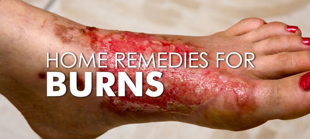 7 Best Home Remedies To Heal Burns Fast | Being Girlish