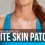 white skin patches